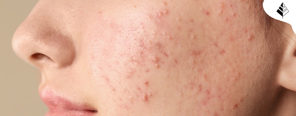Skin Purging cosa è